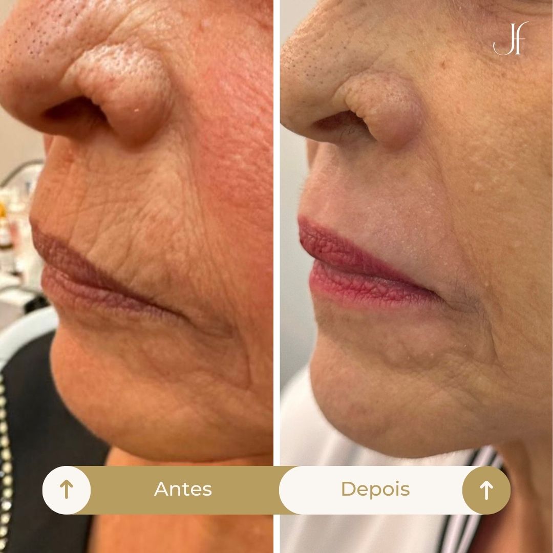 Procedimento: Peeling de fenol cróton localizado