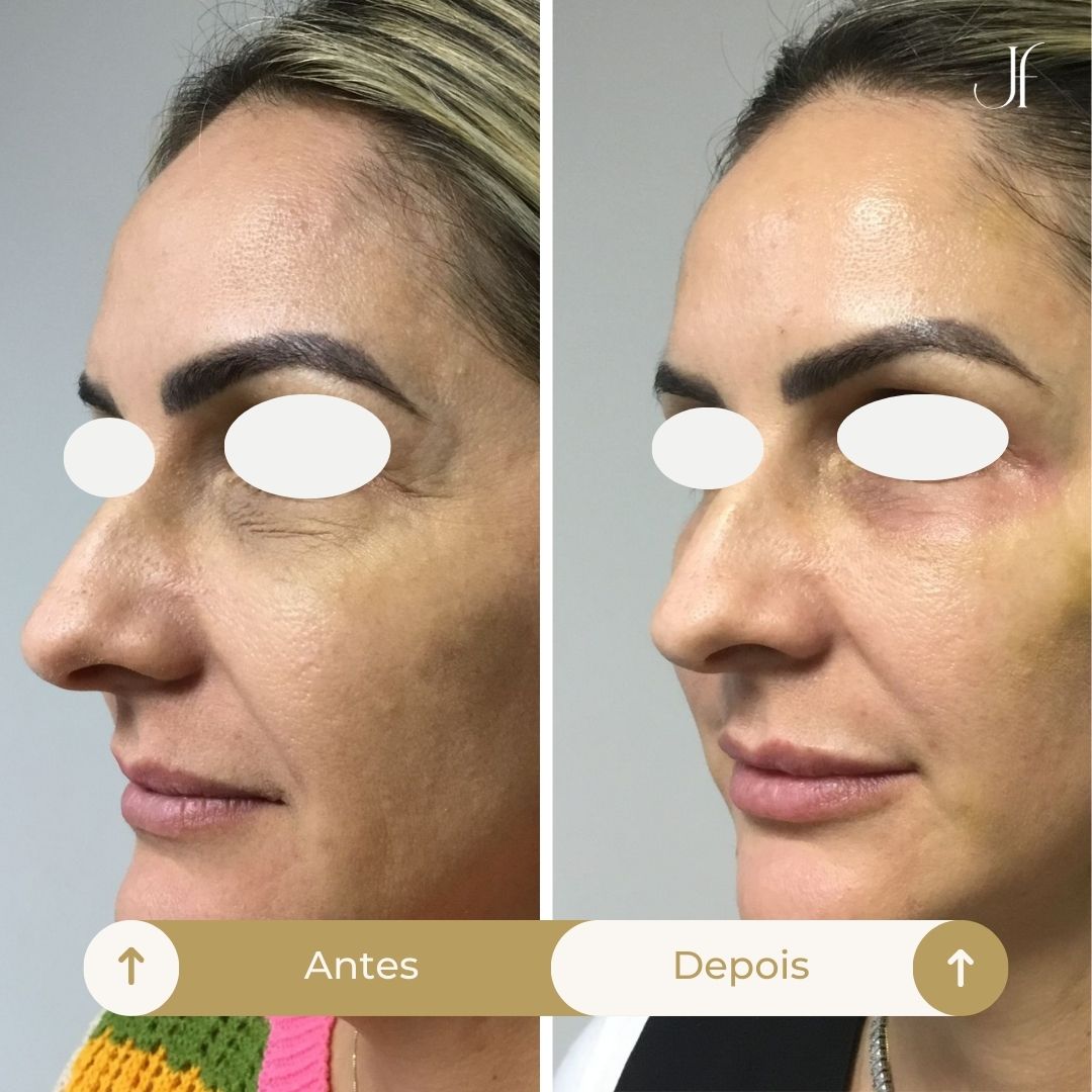 Procedimento: Preenchimento facial com ácido hialurônico