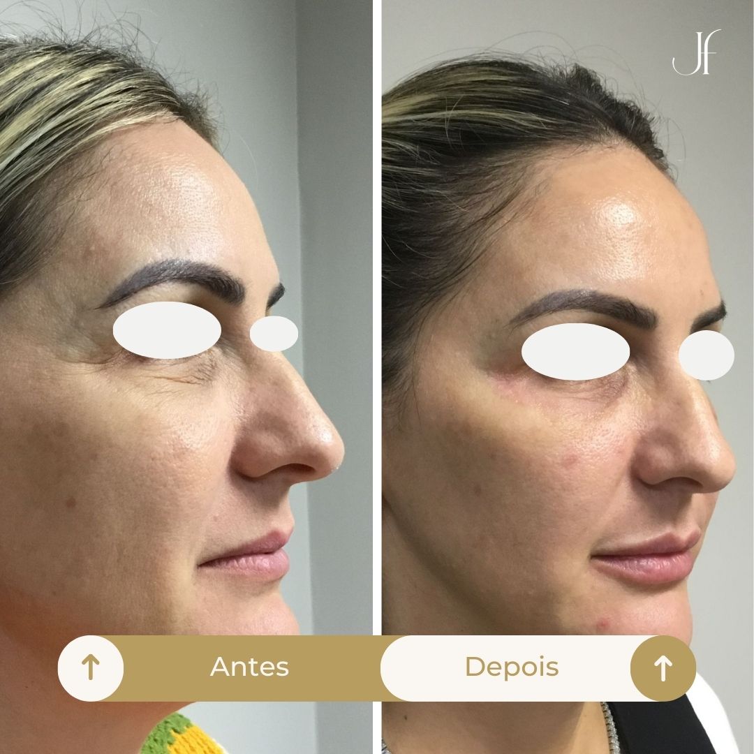 Procedimento: Peeling de fenol cróton localizado