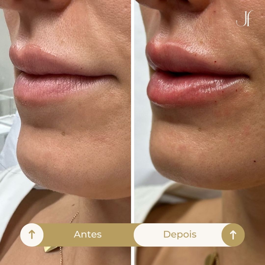 Procedimento: Preenchimento facial com ácido hialurônico