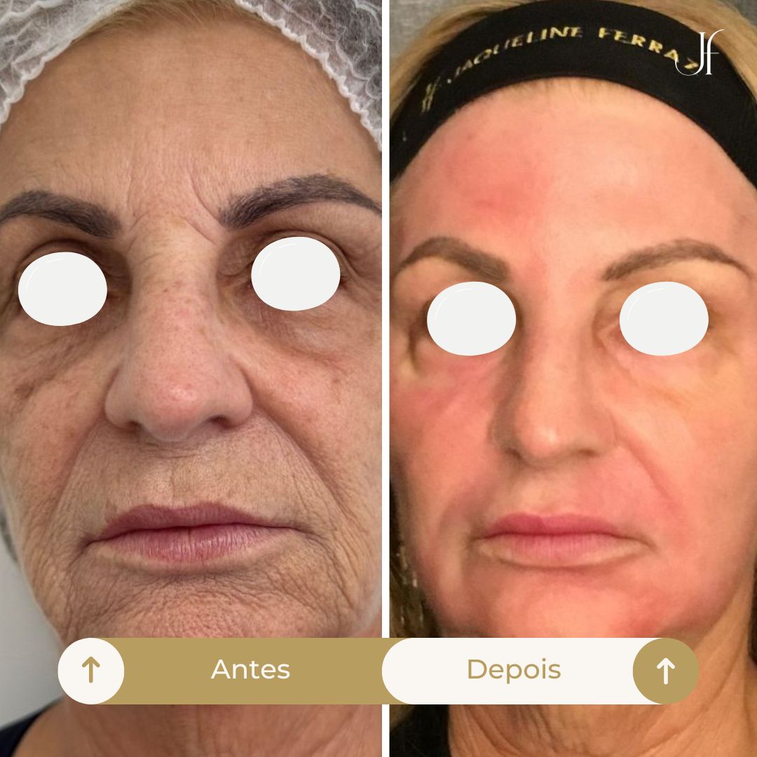 Procedimento: Peeling de Fenol-Cróton Full Face