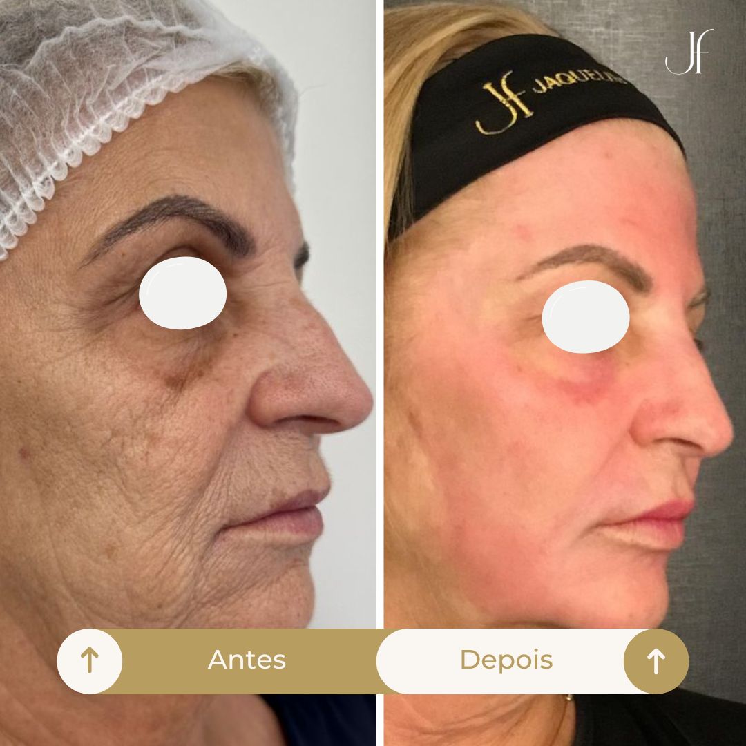 Procedimento: Peeling de Fenol-Cróton Full Face